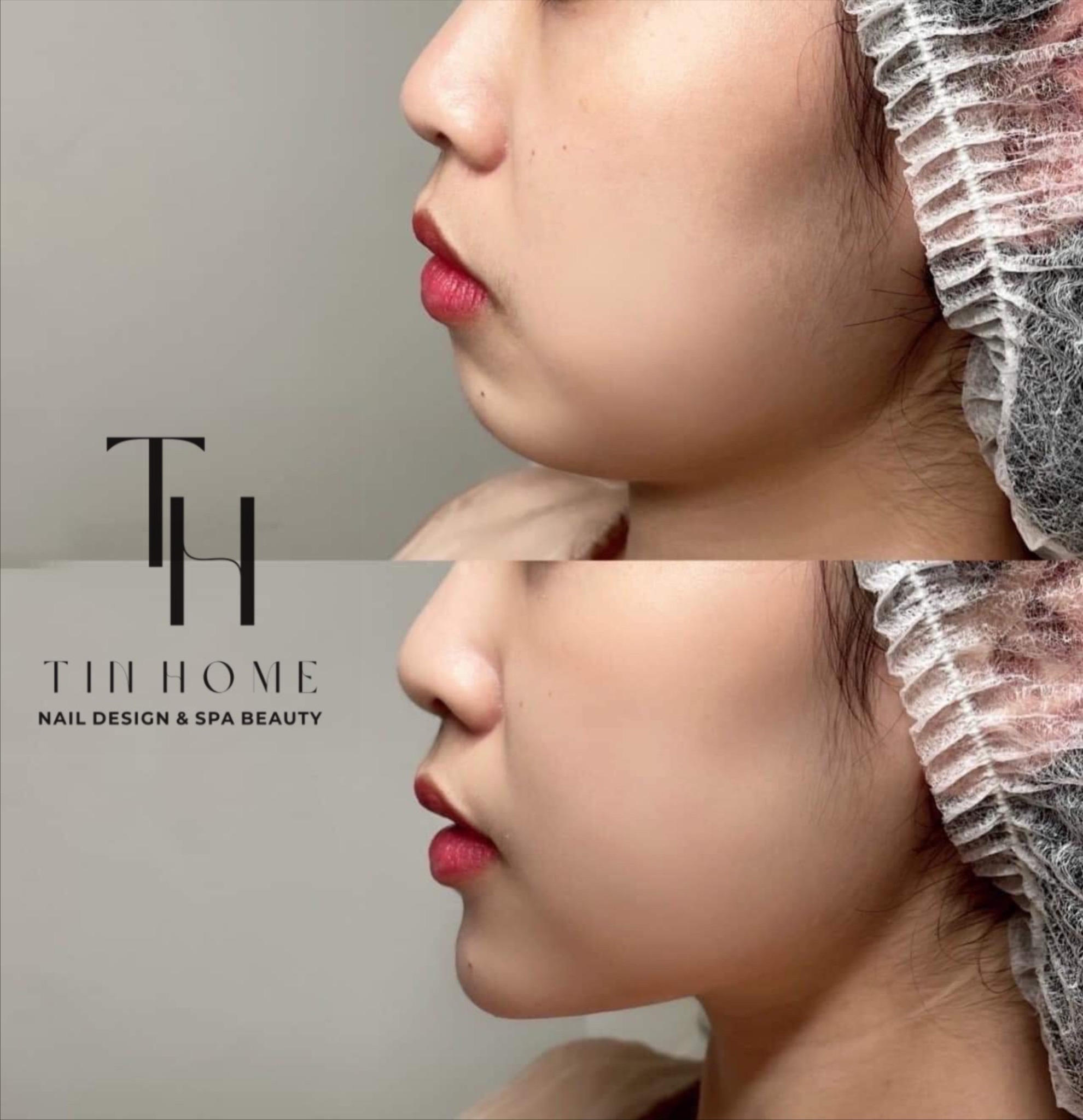 Filler cằm