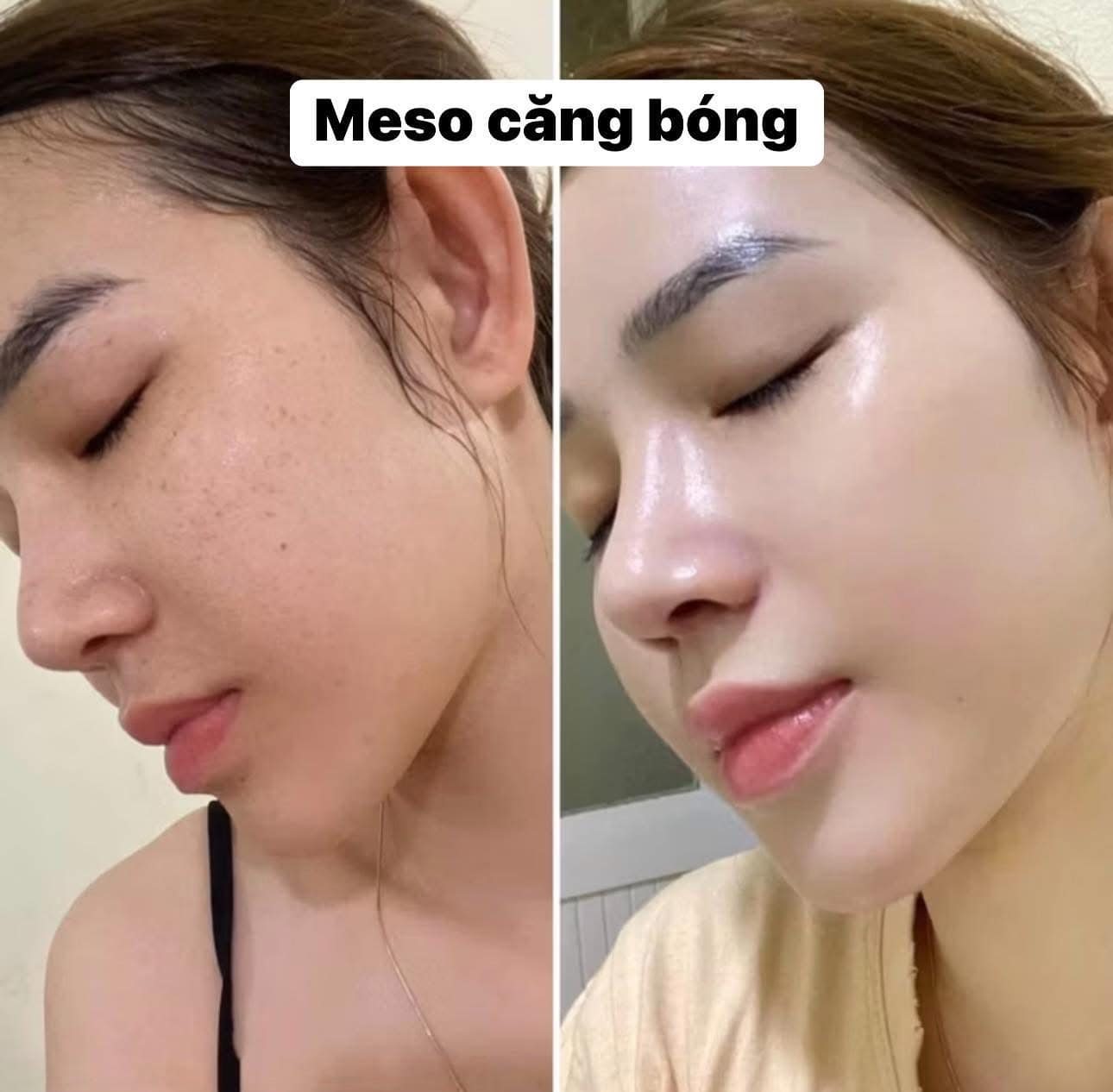 Meso căng bóng